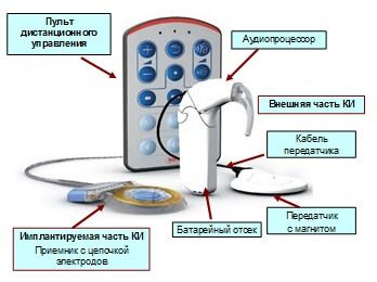 Рисунок 2. Внешняя и имплантируемая части кохлеарного импланта. Расположение внешней части кохлеарного импланта на голове пациента