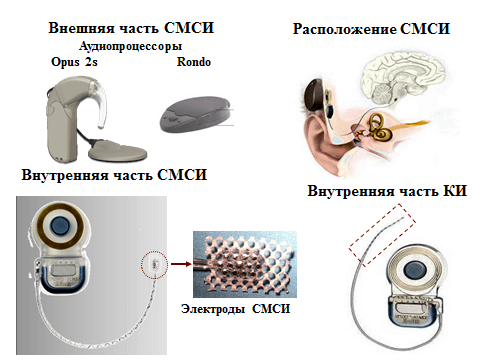 Рис.1. Внешняя и имплантируемая части стволомозгового слухового импланта.