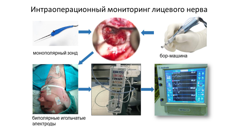 Интраоперационный мониторинг лицевого нерва